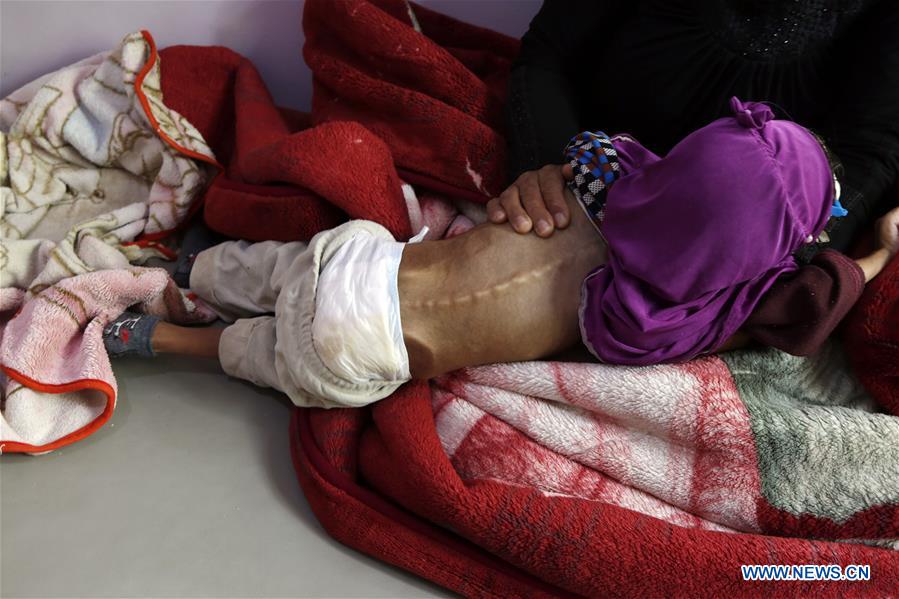 YEMEN-SANAA-CHILDREN-MALNUTRITION